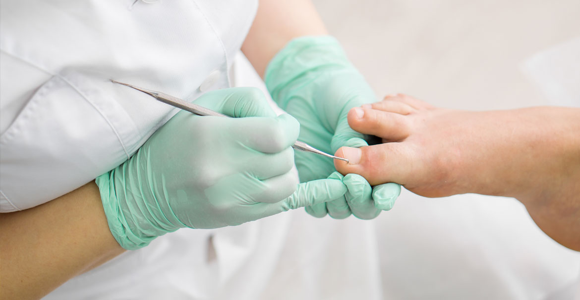 sposoby-na-wrastajace-panokcie-wkladki-ortopedyncze-wkladki-mazbit-deformacje-przyczyny