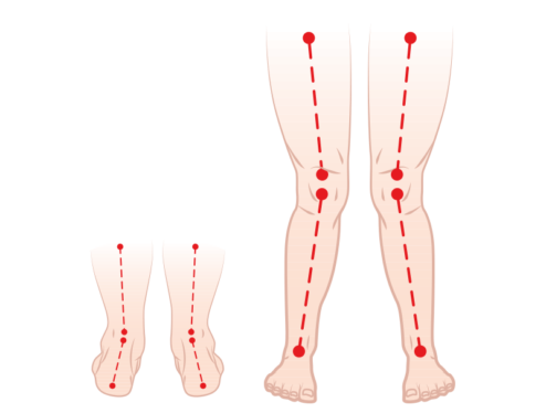 koslawe-ustawienie-kolan-koslawosc