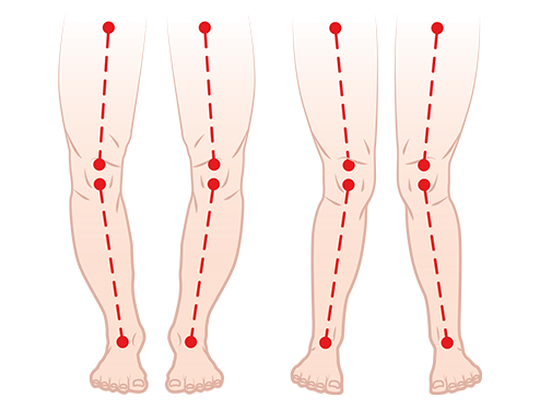 Koślawość szpotawość stóp