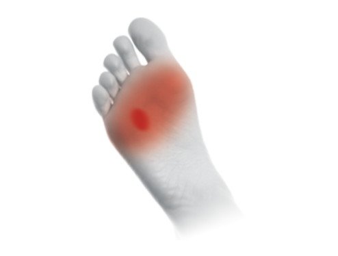 Wpływ metatarsalgii na bieganie